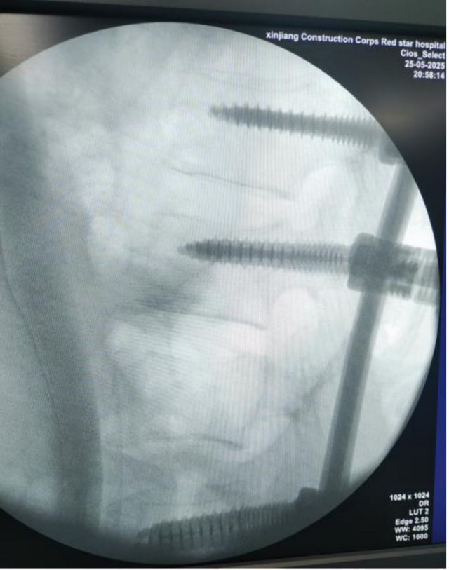 河南脊柱外科专家紧急驰援 救治腰椎外伤导致的马尾神经压迫