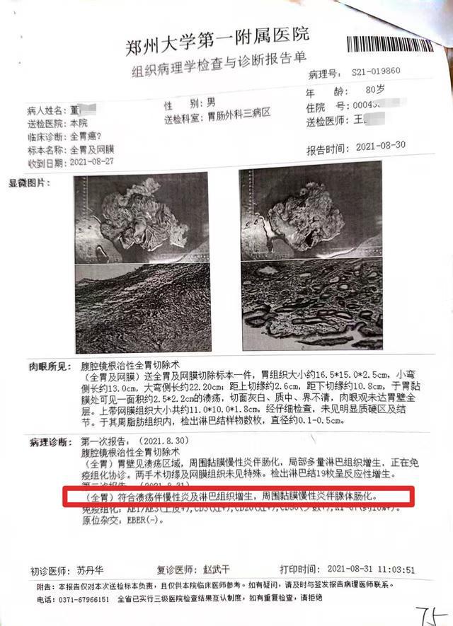 79岁老先生患慢性胃炎，被按胃癌晚期切除全胃；两级鉴定：构成二级医疗事故，院方负主责