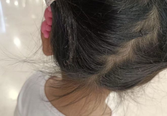 花15元买的气球爆炸，女童胳膊汗毛和后脑勺头发烫卷，宝妈发视频提醒吸取教训